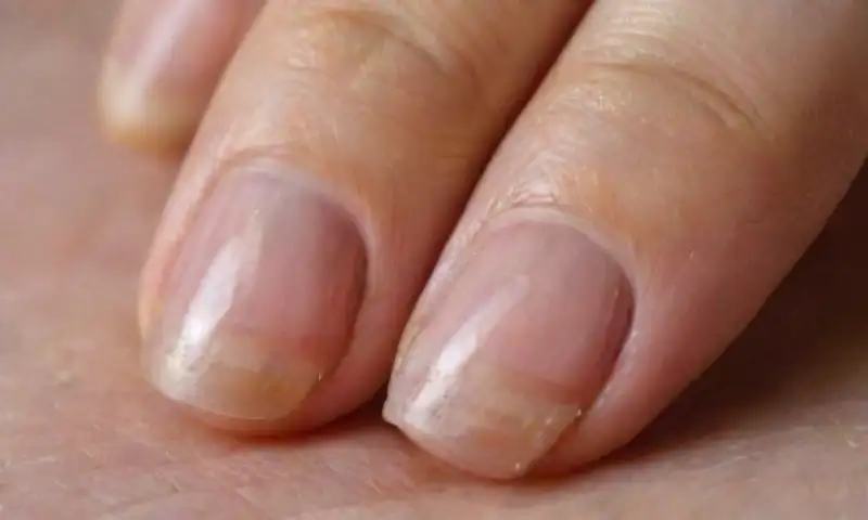 Una uña del pie humano en mal estado, con superficie irregular, decoloración amarillenta y marrón, bordes quebrados, cutícula desgastada y signos de infección fúngica