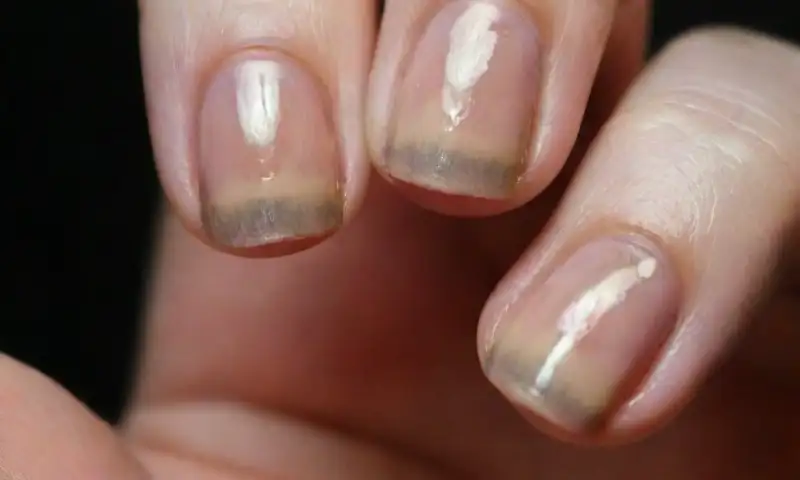 Uñas amarillentas y desiguales con imperfecciones que sugieren descuido y hongos