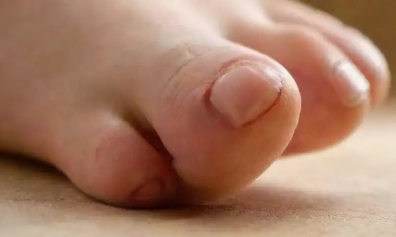 Primer plano de un pie con un dedo afectado, mostrando una uña cóncava y texturas sutiles en la piel, todo iluminado por luz natural