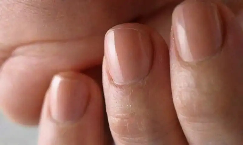 Una mano con coiloniquias muestra uñas cóncavas y detalles realistas bajo luz natural